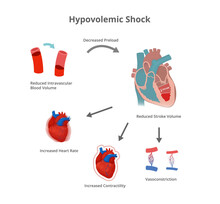 Hypovolemic Shock Pathology. Compensatory Mechanisms Of Hypovolemic Shock