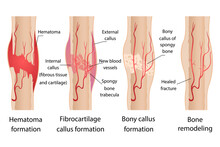 Stages Of Healing Of Bone Fractures.