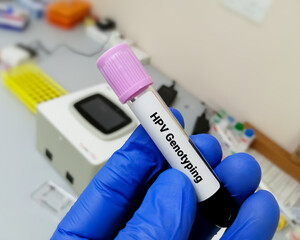 Canvas Print - Blood sample for Human papillomavirus (HPV) genotyping testing in PCR laboratory