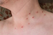 © broniktav - Red dots on the neck after removal of papillomas and warts.