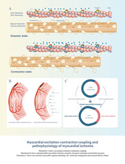 The increase of ventricular end diastolic pressure will affect the subendocardial myocardial blood supply. In addition, acute myocardial segmental ischemia will affect cardiac function.