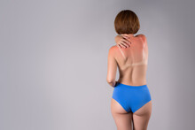 Sunburned Woman, Sunburn Marks On Nude Back