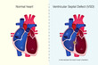 The difference of normal heart and ventricular septal defect (VSD) vector. Congenital heart defect.