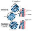 Varicose veins infographic diagram for physiology science medical education superficial deep distended wall blood flow direction normal valve closed incompetent fail gravity force vector
