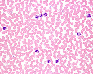 Poster - Human blood smear. Leukocytosis