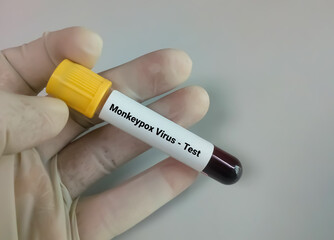 Poster - Blood sample for Monkeypox virus test. It is also known as the Moneypox virus, a double-stranded DNA virus and member of Poxviridae family.