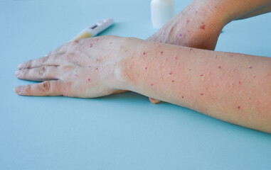 Monkey pox virus, a new world problem of modern humanity. Close-up of the hands of a sick person with pimples and blisters.