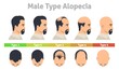 Male type alopecia poster hair loss stage