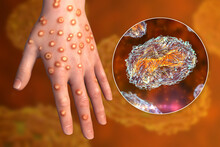 Hand Of A Patient With Monkeypox Infection, 3D Illustration