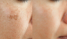 Cropped Image Before And After Spot Melasma Pigmentation Facial Treatment On Middle Age Asian Woman Face. Skincare And Health Problem Concept.
