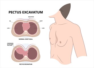 Chest wall disorder and Pectus ribs sunken funnel heart murmur lung COPD pain gene birth the barrel Marfan Ehlers Danlos Noonan Turner head thorax muscle brace sport injury Pleural effusion asthma