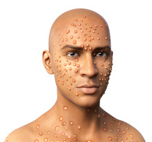 Patient With Monkeypox, 3D Illustration