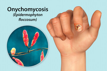 Sticker - Human hand with onychomycosis