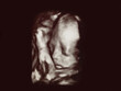 fetal baby ultrasound picture