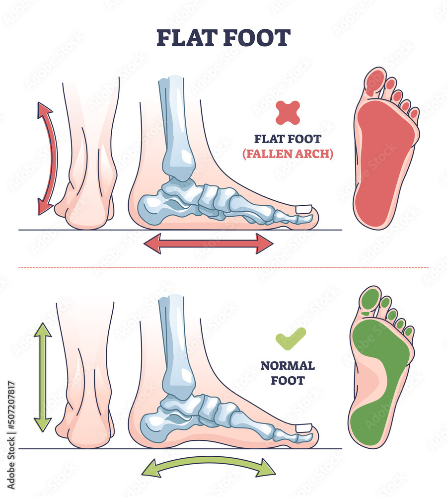 Flat foot vs normal arch comparison diagram showing the difference in foot structure and arch support