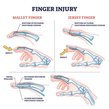 Finger injury types with common hand impact trauma anatomy outline diagram. Labeled educational scheme with mallet and jersey phalanx ligament disorder vector illustration. Sport pain explanation.