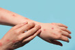 Monkeypox new disease dangerous over the world. Patient with Monkey Pox. Painful rash, red spots blisters on the hand. Close up rash, human hands with Health problem. Banner, copy space. Marv