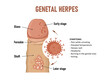 © nmfotograf - Genital herpes. Herpes simplex virus