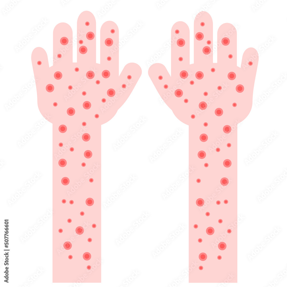 Skin rash.Hands with skin problems concept isolated.Monkeypox or ...