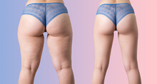 Overweight Woman With Fat Cellulite Legs And Buttocks, Before After Weight Loss Concept On Purple Pink Gradient Background