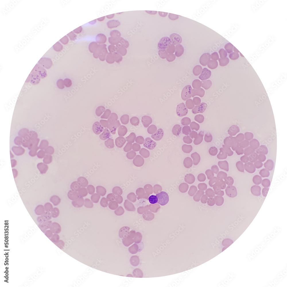 Reticulocyte Stain Retics_Sam • The Blood Project