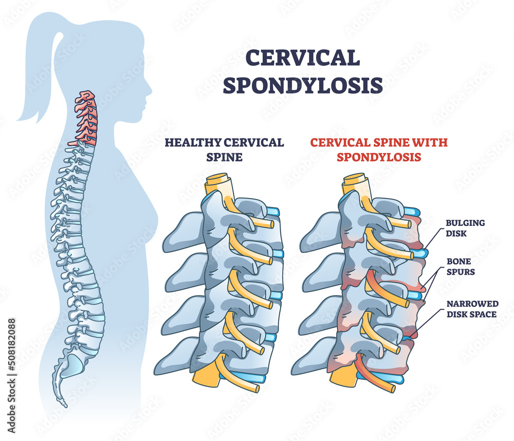 Cervical spondylosis problem compared with healthy spine outline ...