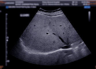 Sticker - Ultrasound upper abdomen showing  liver.