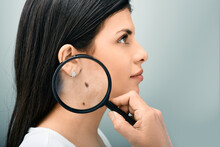 Woman With Magnifying Glass Showing Mole And Birthmark On Her Body For Prevention Of Melanoma And Nevus Exam. Mole Dermoscopy