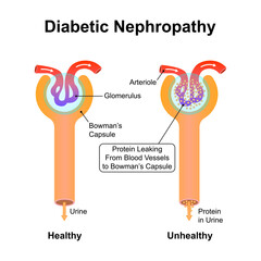 Scientific Designing of Diabetic Nephropathy. Common Complication of Type 1 and Type 2 Diabetes. Colorful Symbols. Vector Illustration.