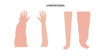 Lymphedema Of Arm And Leg