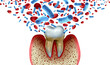 Tooth decay and blood bacteria and disease as an unhealthy molar with periodontitis due to poor oral hygiene health problem as a bacterial infection with inflammation