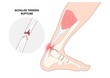 Rupture of Achilles tendon injury Feet calf test range of motion slight ache problem limb Thompson Simmonds torn