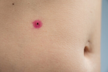 Wall Mural - Close-up of a removed wart on a woman's abdomen. Human papillomavirus after burning.