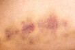 © Vera - Bruises on the human body. Severe bruise from impact, bruising and hematoma.