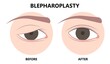 © Pepermpron - Before and after of drooping eyelid lift surgery or blepharoplasty surgical procedure to treat removes excess skin