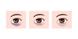 © barks - Color types of dark circles under eyes. Vector illustration