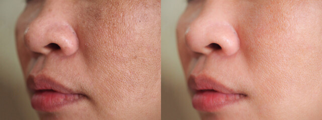 Image before and after spot melasma pigmentation facial treatment on face asian woman.Problem skincare and health concept.