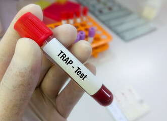 Wall Mural - Blood sample for Tartrate resistant acid phosphatase (TRAP) test in laboratory for the diagnosis of hairy cell leukemia.