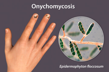 Wall Mural - Human hand with onychomycosis