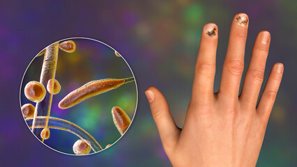 Sticker - Human hand with onychomycosis