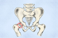 Illustration Of A Broken Femur Neck Or Broken Hip