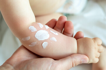 cute little baby hand and sun shape drawn with protective cream.toddler with red burned skin,sun dam