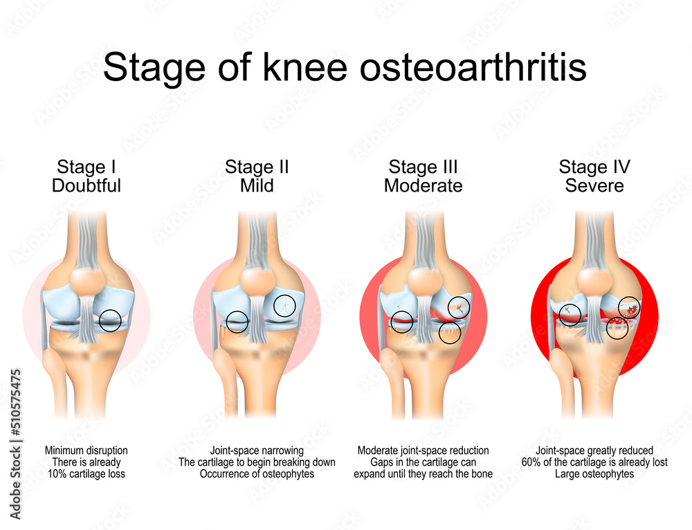 Stages of knee osteoarthritis Stock Vector | Adobe Stock