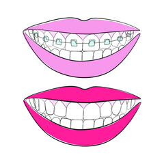 Wall Mural - Teeth with braces one line drawing on white isolated background. Female smile vector illustration