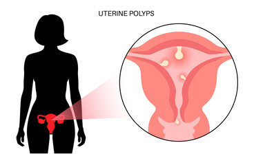 Wall Mural - Uterus Polyps Disease