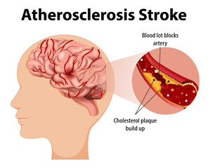 Sticker - Human anatomy with atherosclerosis stroke