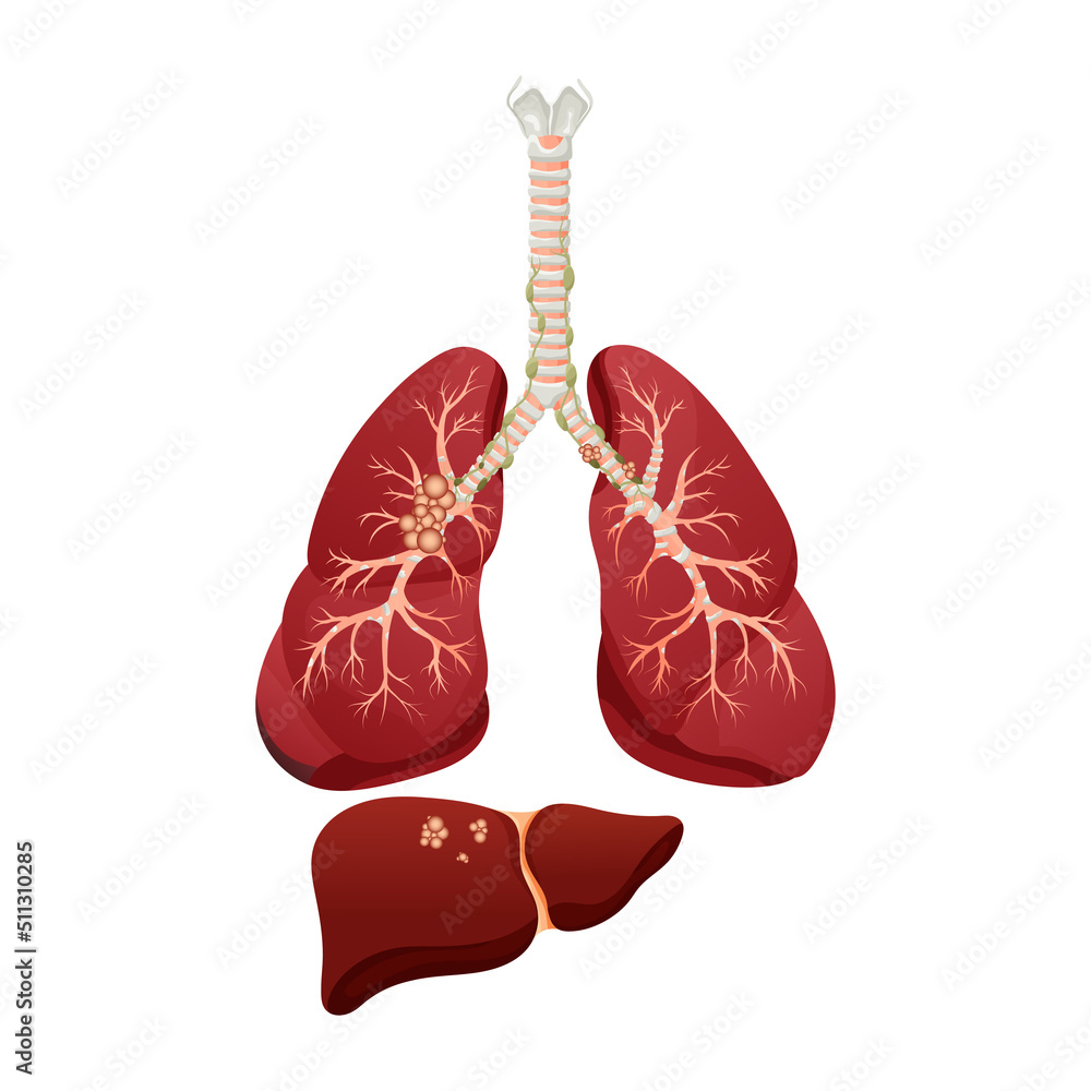 Diagram lung cancer disease. Concept disease human internal organs ...