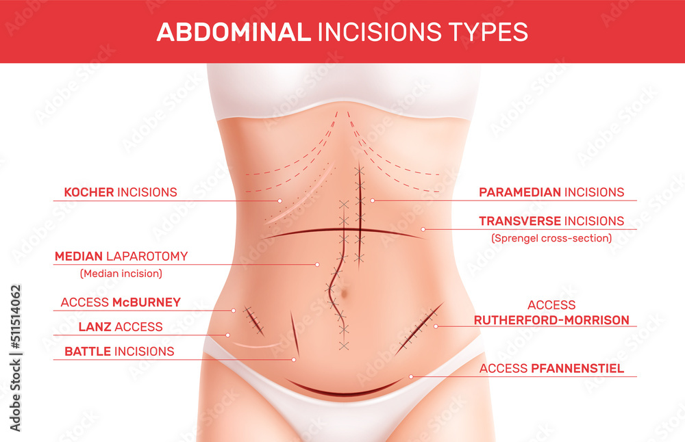 Types Of Surgical Incisions On The Abdomen Pdf - Infoupdate.org