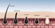 © Vectorman2017 - Hair removal comparison chart by shaving, waxing, depilatory creams, epilator and laser hair removal. EPS Realistic file.