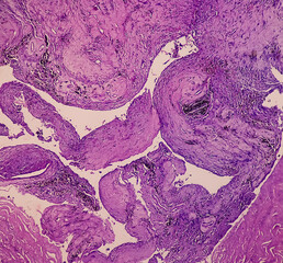 Wall Mural - Photomicrograph of Schwannoma, a benign soft tissue tumor, enlarged cysts can compress the sciatic nerve, causing sciatica. Nerve tumors.